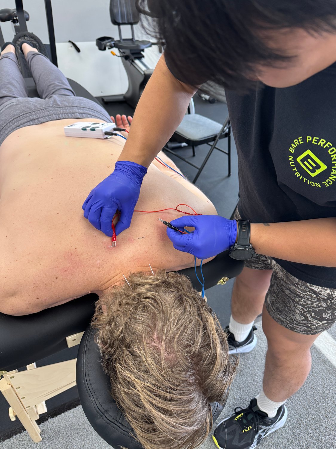 dry-needling-physical-therapy