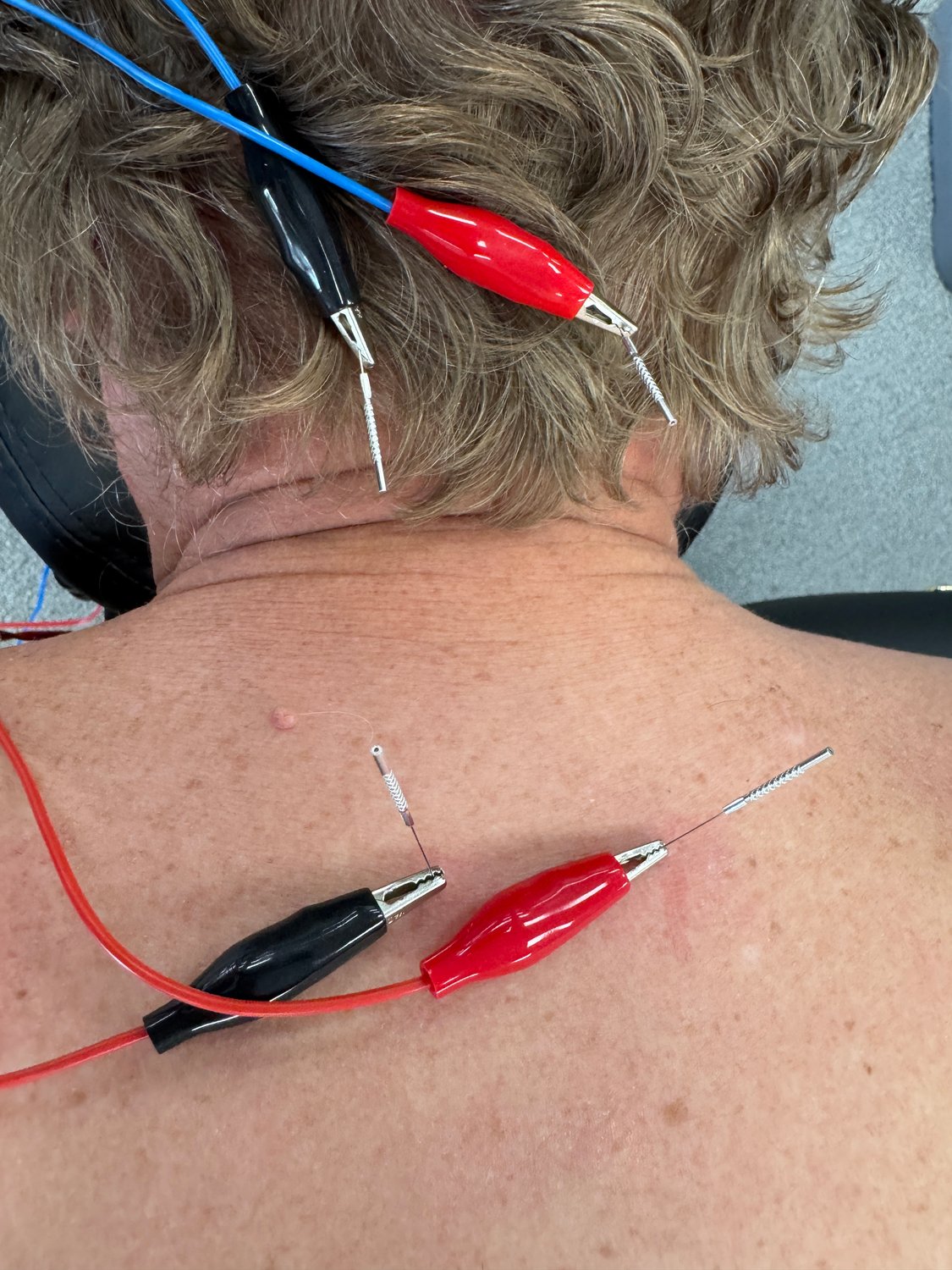 dry-needling-physical-therapy