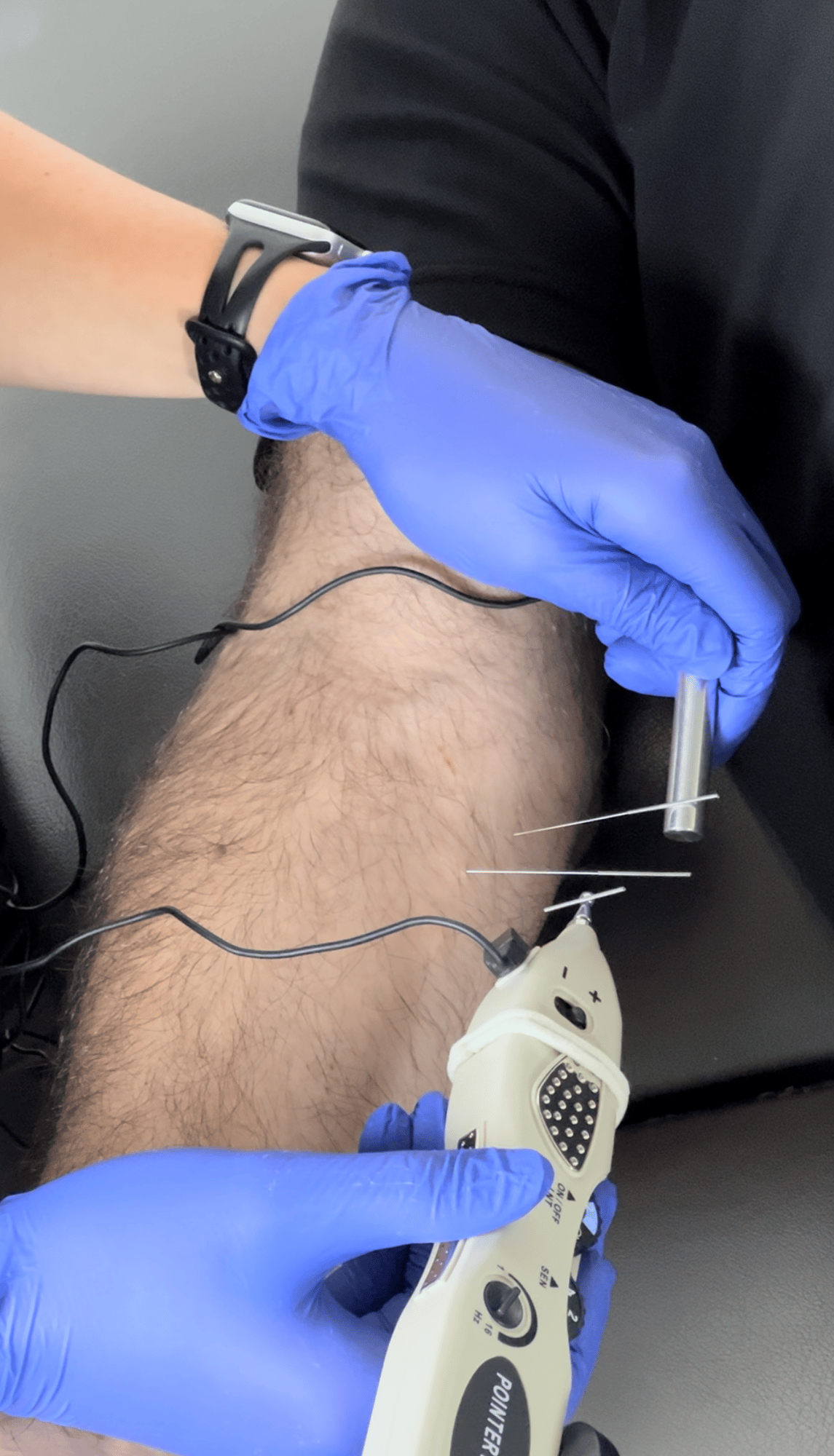 dry-needling-physical-therapy